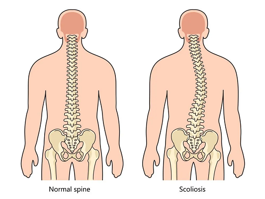 Scoliosis Chiropractor Near Me