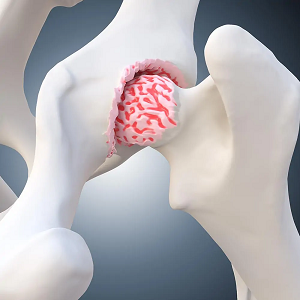 Arthrose Ernährung Übersäuerung